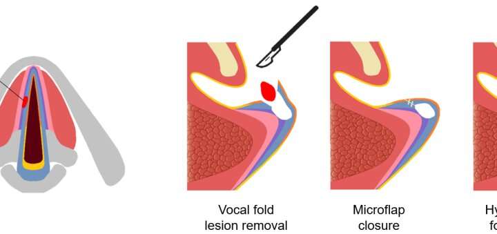 vocal cords damaged