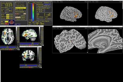 Researchers use brain-injury data to map intelligence in the brain