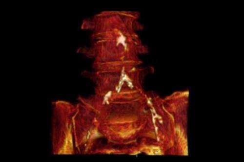 This CT with 3D volume rendering shows the aortic and iliac calcification in a mummified Egyptian woman aged 45-50
