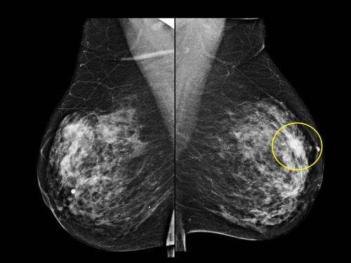 乳房x线筛查间隔时间可能影响乳腺癌预后