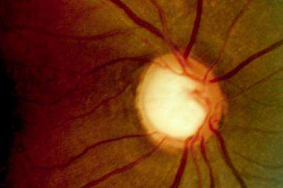 $6.4 million grant funds glaucoma study in African-Americans