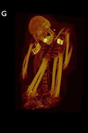 This 3D MIP shows a mummified woman aged 41-44 from ancient Peru, who was excavated from Huallamarca, Peru