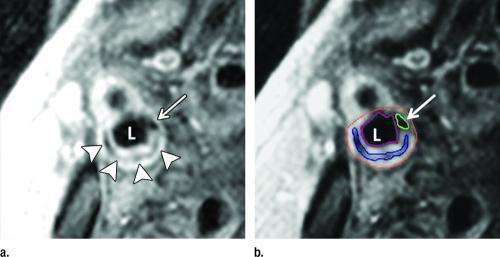 颈动脉MRI有助于预测中风和心脏病发作的可能性
