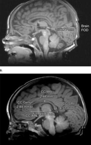 MRI显示了晚期早产儿的大脑异常