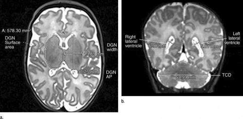 MRI显示了晚期早产儿的大脑异常