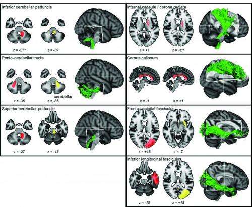 Wii平衡板诱导MS患者的大脑发生变化