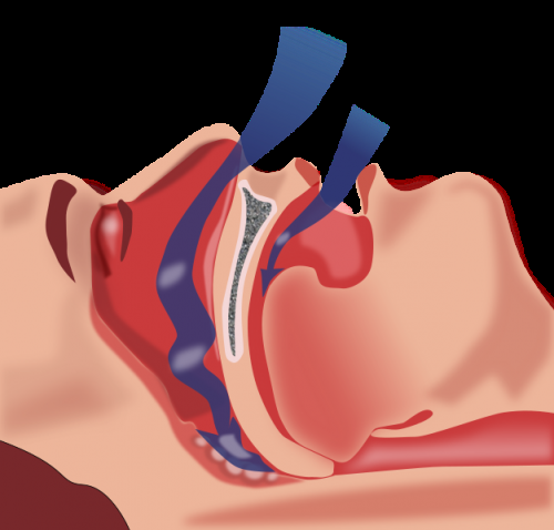 Sleep apnea may be risk factor for COVID-19 thumbnail