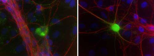 来自脑细胞的毒素触发人ALS模型中的神经元损失