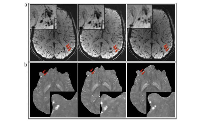 MRI可提高军人脑损伤后微出血的诊断