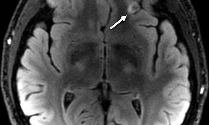 MRI显示脑创伤的军事人员blast-related脑震荡