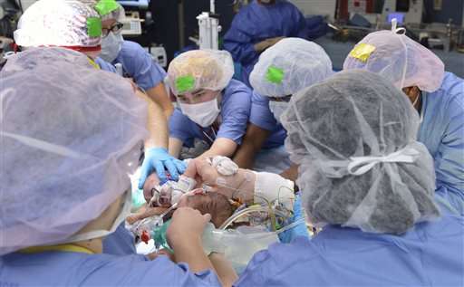 Hospital: Conjoined twin girls successfully separated