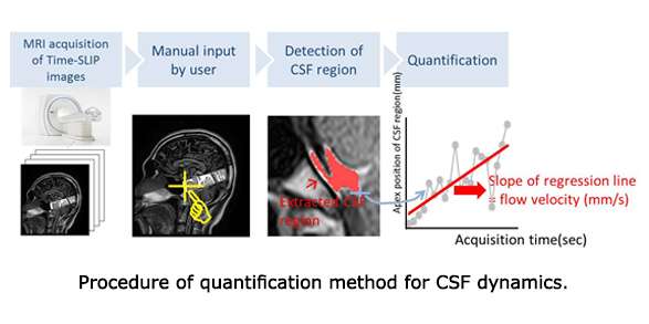 Novel method for quantifying cerebrospinal fluid flow dynamics uses magnetic resonance image analysis