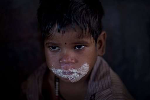 Food politics hits India's most malnourished children