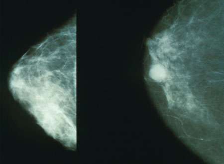 New mammogram measures of breast cancer risk could revolutionise screening thumbnail
