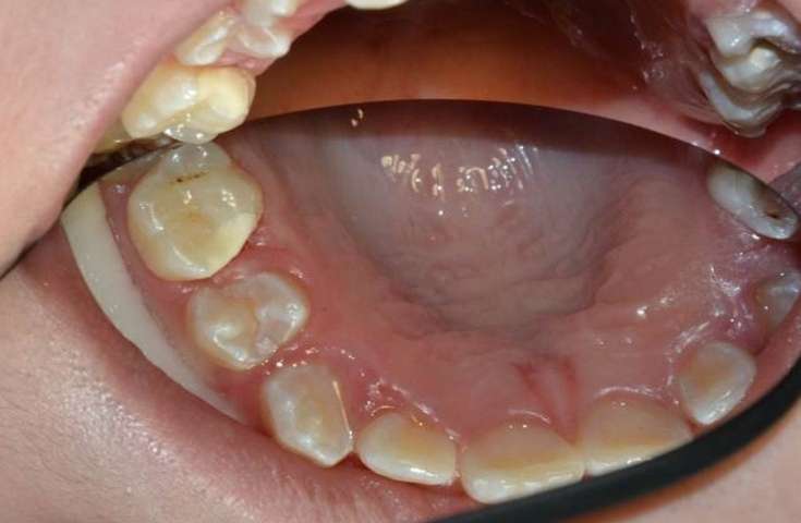 glass tooth filling