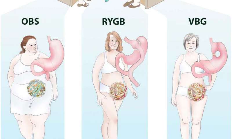 Weight Loss Surgery Benefits For Gut Microbiome Last At Least A Decade
