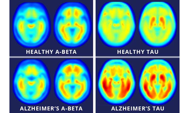 Brain imaging links Alzheimer's decline to tau protein