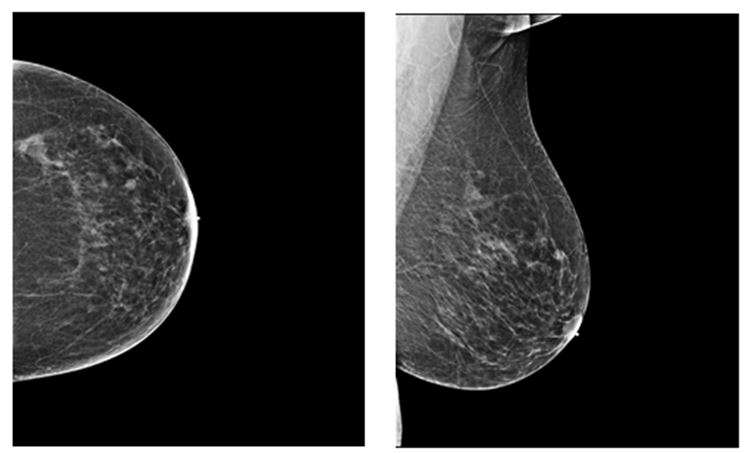 量化乳腺癌风险的乳房密度