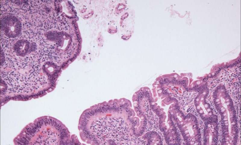 研究发现乳糜泻风险与非编码RNA之间的联系