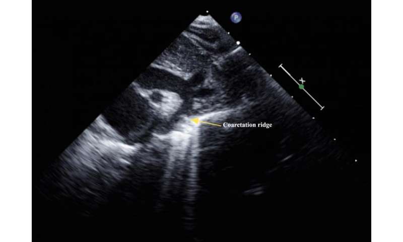 Ultrasound Detects Heart Dysfunction After Successful Repair Of