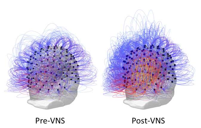 After 15 years in a vegetative state, nerve stimulation restores consciousness