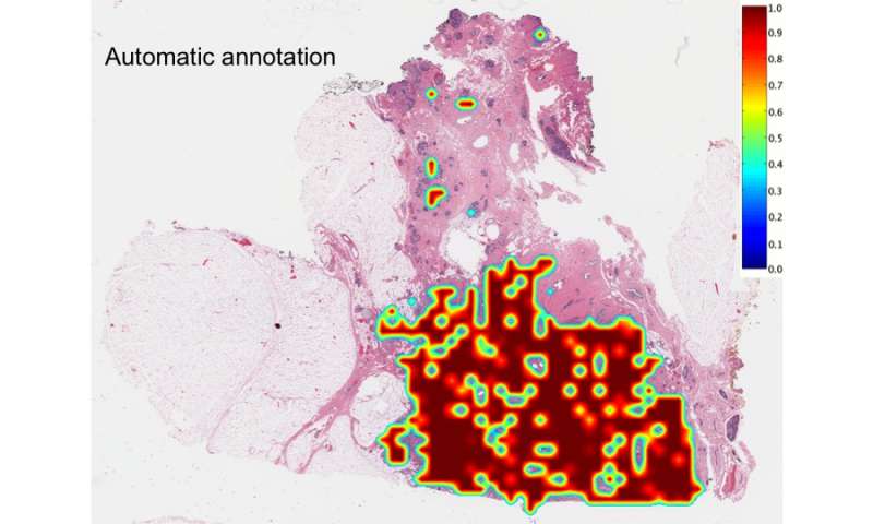 计算机在数字组织切片上准确地识别和描绘乳腺癌