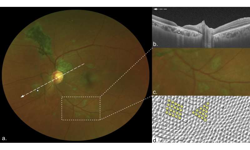 埃博拉幸存者有一个“独特”视网膜疤痕