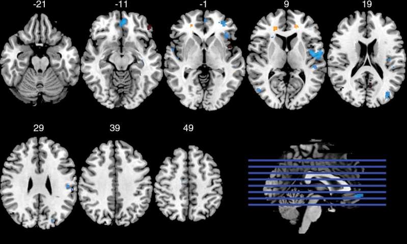Football position and length of play affect brain impact