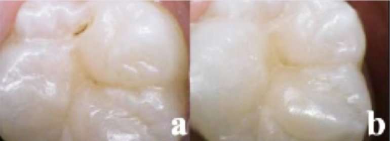 无痛激光可以使牙齿防止蛀牙