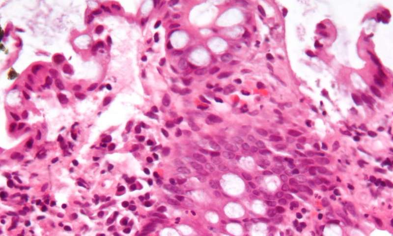 People with inflammatory bowel disease still die earlier despite increase in life thumbnail