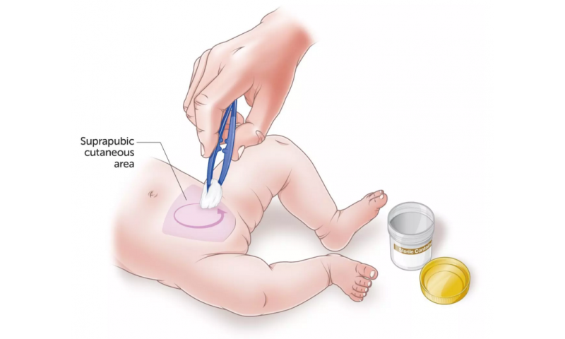 快速从婴儿获取尿液样本的技术