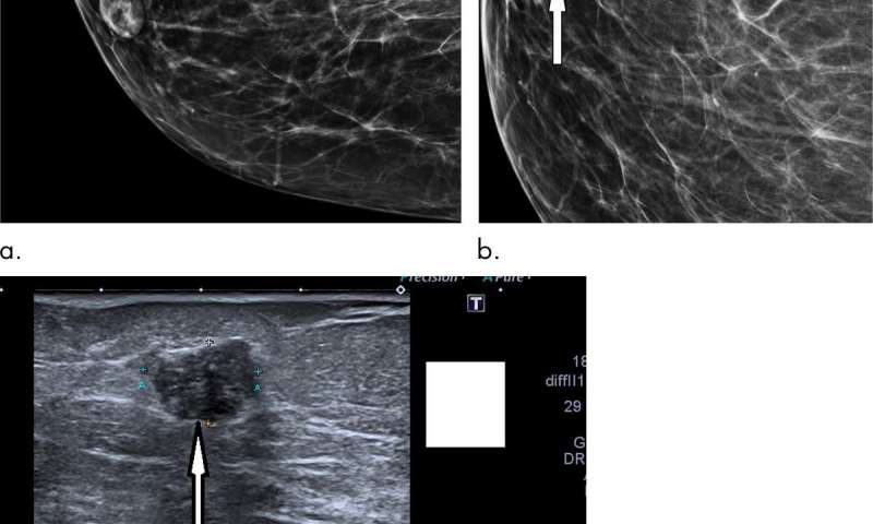 数字乳房x光检查增加了乳腺癌的检测