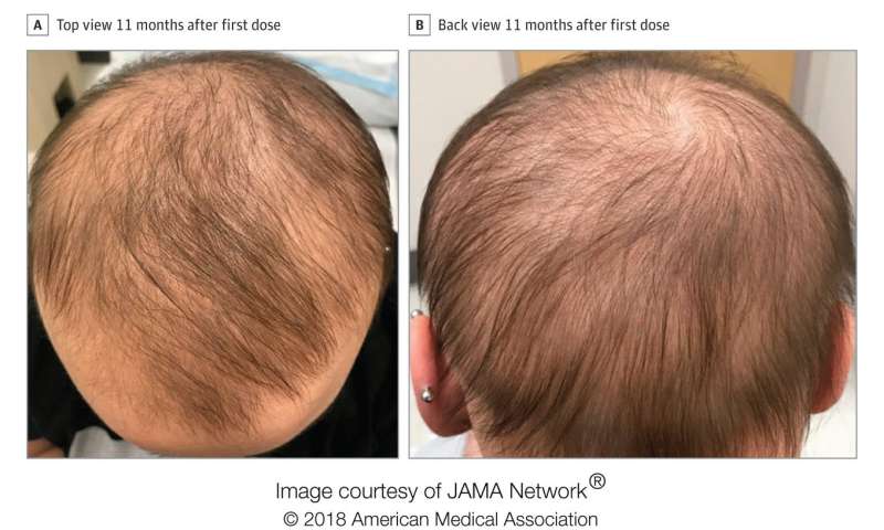 Eczema drug restores hair growth in patient with longstanding alopecia