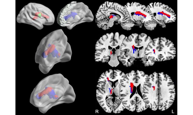 Impaired brain pathways may cause attention problems after stroke