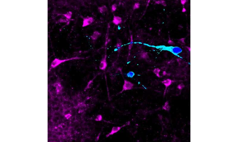 Neurons derived from super-obese people respond differently to appetite hormones