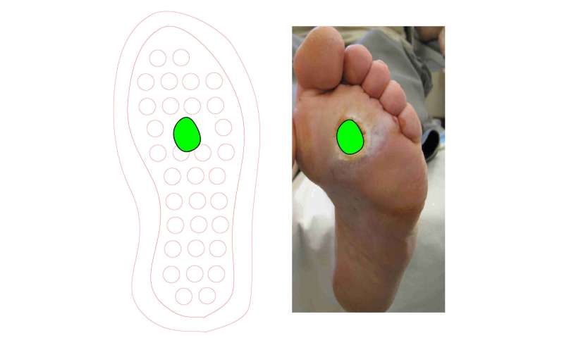 Ulcers from diabetes? New shoe insole could provide healing on-the-go