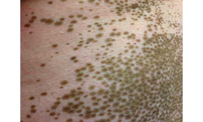 New treatment in the works for disfiguring skin disease vitiligo
