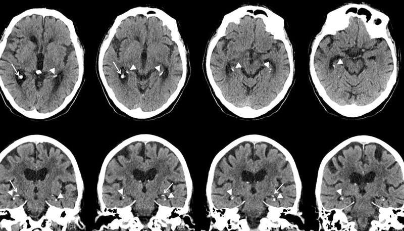 Smoking and diabetes linked to brain calcifications