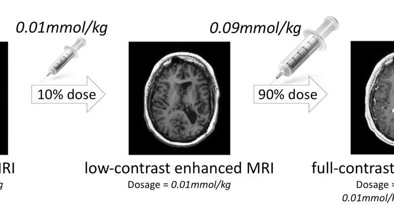 Artificial intelligence may help reduce gadolinium dose in MRI