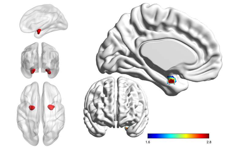 Looking Inside The Brain To Distinguish Bipolar From Depression