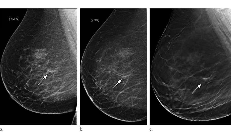 3D mammography significantly reduces breast biopsy rates
