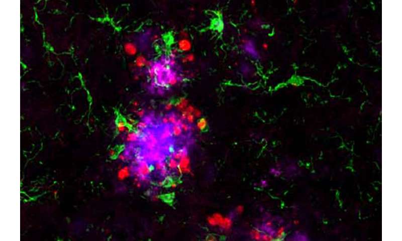 Alzheimer's missing link ID'd, answering what tips brain's decline
