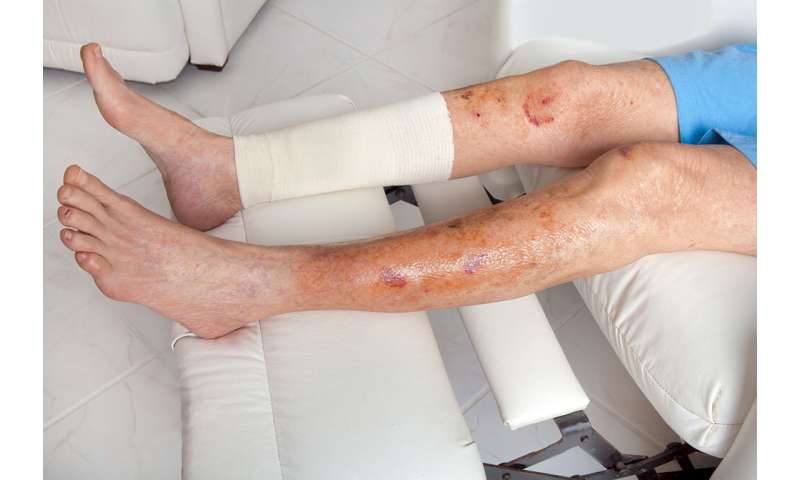 “早期预警”工具hard-to-heal腿伤口