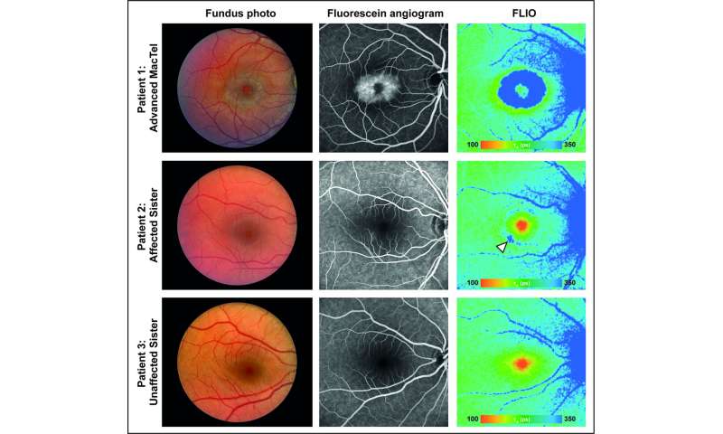 Genetic discovery linked to rare eye disease, MacTel