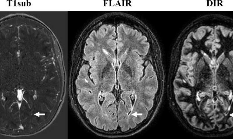 Non-contrast MRI is effective in monitoring MS patients
