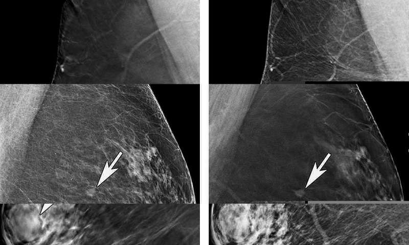 老年女性在接受3D乳房x光检查时获益显著