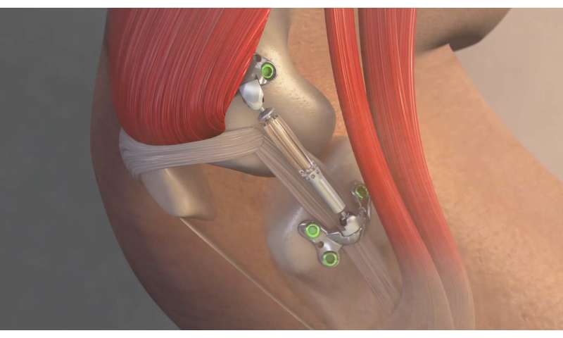 OSU Wexner Medical Center first in US to implant device for knee osteoarthritis