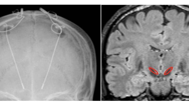 帕金森病患者脑深部脑电波的自主控制
