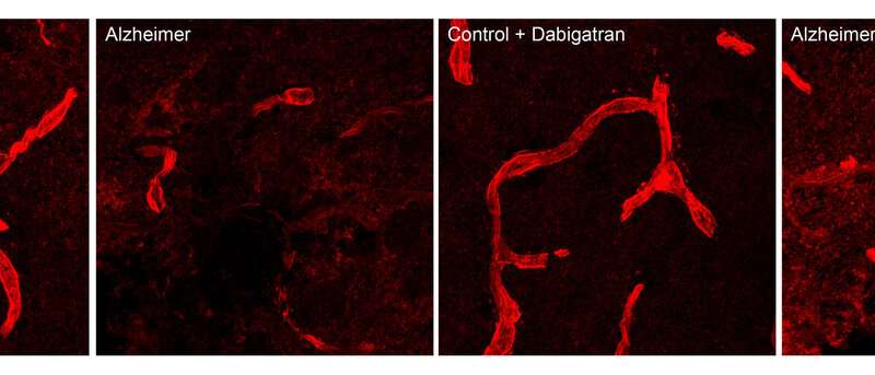 An oral anticoagulant delays the appearance of Alzheimer's disease in mice