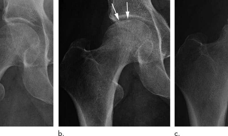 Steroid injections of hip and knee may damage joints